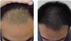 治疗脱发，还不赶紧来扬州京城皮肤病研究所！