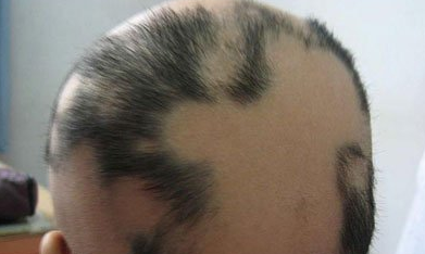 扬州看斑秃哪里好