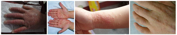 手部湿疹的有效治疗方法