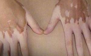 引起女性白癜风的原因是什么