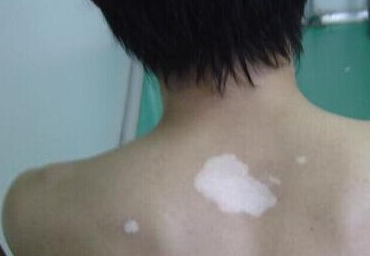 白癜风治疗用什么方法好