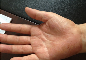 手癣有哪些常见症状