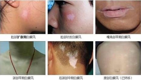 白癜风五个致病因素