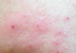 秋季皮炎止痒方法有哪些？