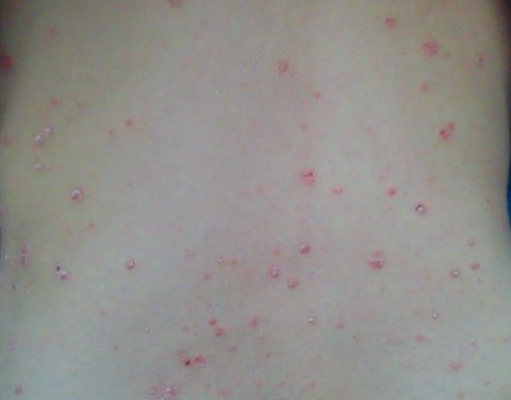 秋季牛皮癣加重了怎么办？